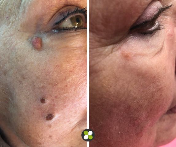 Before & after photos of a woman who has had cryotherapy to remove moles and warts