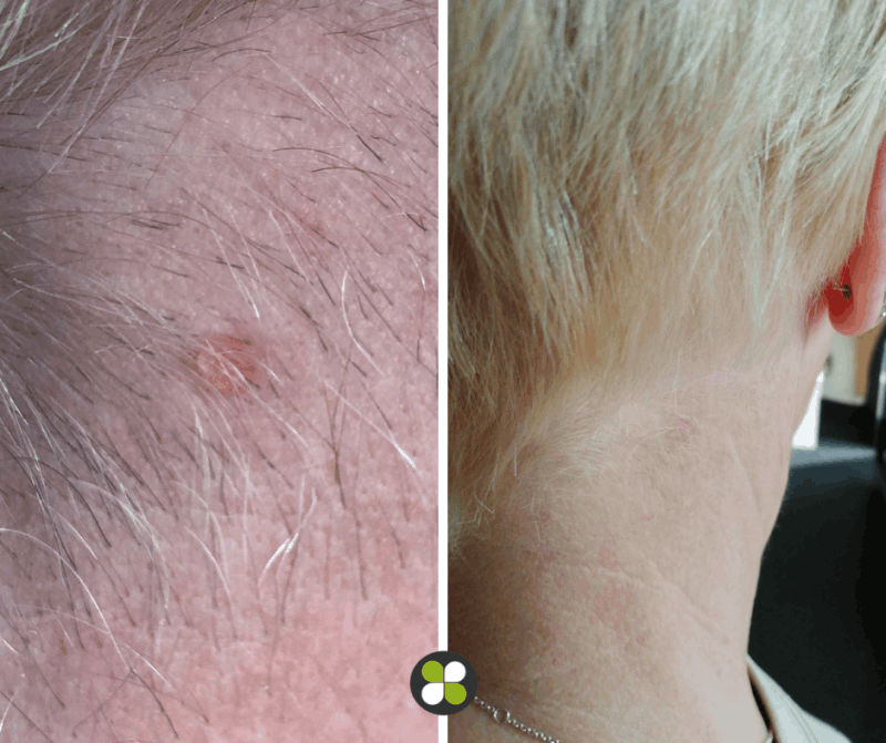 Cryotherapy results - skin tag removal