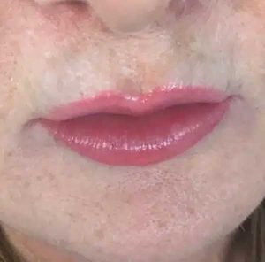Natural looking Lip Fillers
