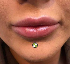 Lip Fillers at Shamrock Clinic, Bedfordshire