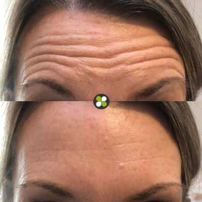 Botox for Frown Lines