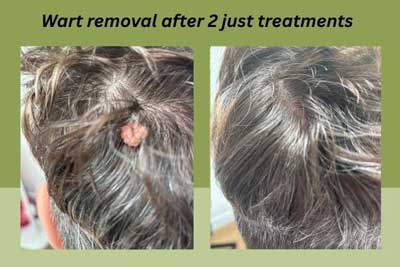 Wart Removal After just Two Treatments at Shamrock Clinic, Bedfordshire