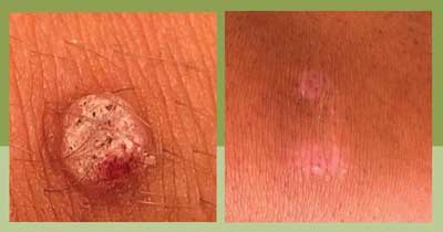 Sterex Blemish Removal in Bedfordshire – Safe & Effective at Shamrock Clinic
