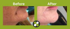 Cheek Fillers at Shamrock Clinic, Bedfordshire